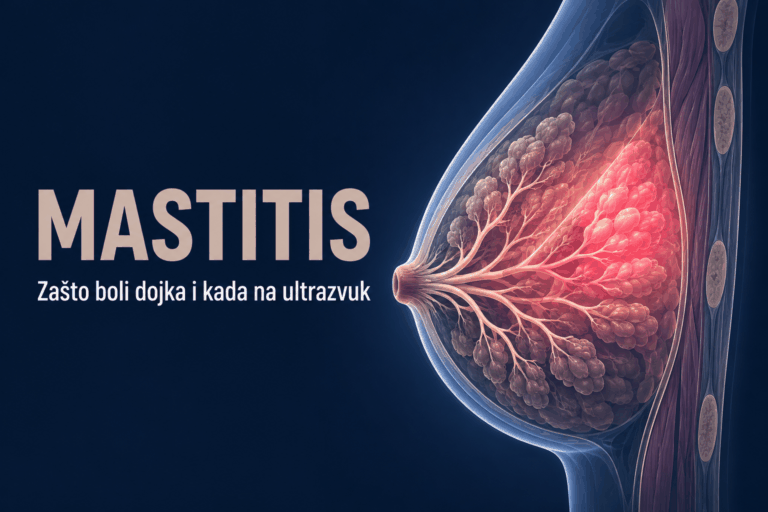 Ilustracija dojke u presjeku sa upaljenim područjem – mastitis, LENUS Banja Luka